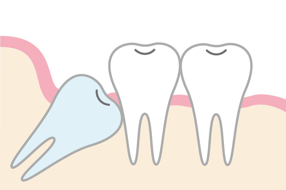 トラブルの原因となる、最後の永久歯「親知らず」