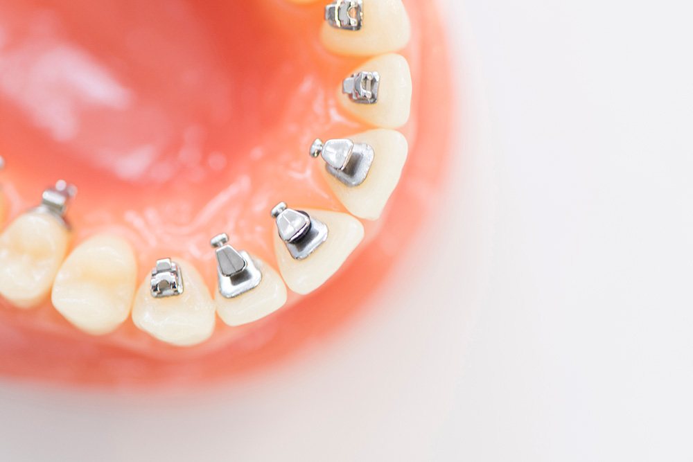 裏側矯正/ハーフリンガル矯正