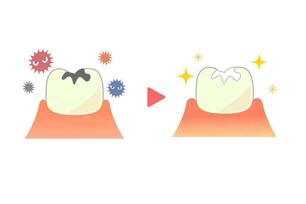 シーラント治療