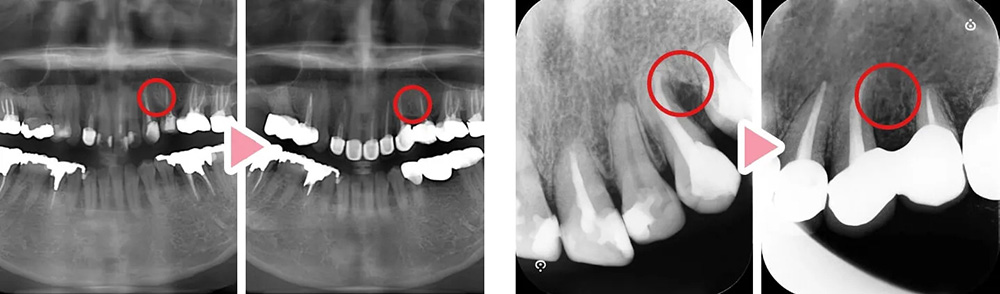 歯周外科による再生治療